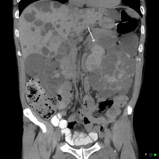 File:Acute hemorrhage in a renal cyst in polycystic disease (MRI) (Radiopaedia 41702-44641 Coronal non-contrast 1).jpg