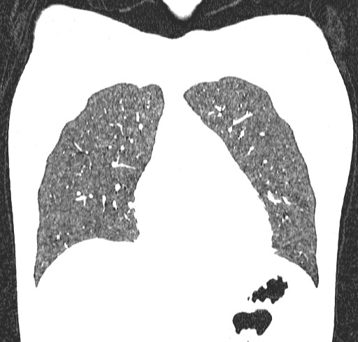 Acute hypersensitivity pneumonitis (Radiopaedia 85293-100870 Coronal lung window 31).jpg