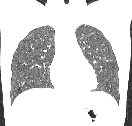 Acute hypersensitivity pneumonitis (Radiopaedia 85293-100870 Coronal lung window 44).jpg