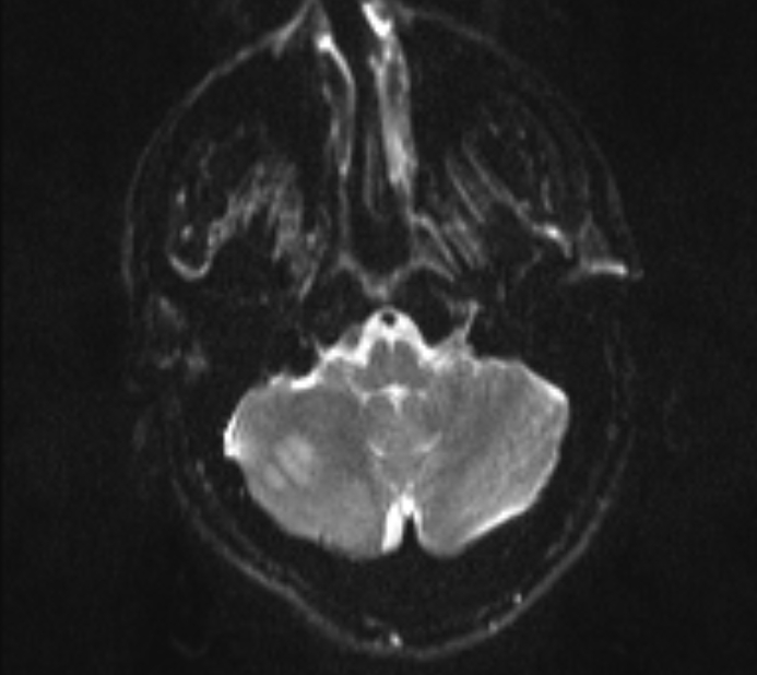 Acute ischemic stroke - posterior circulation territory (Radiopaedia 77670-89880 Axial DWI 5).jpg