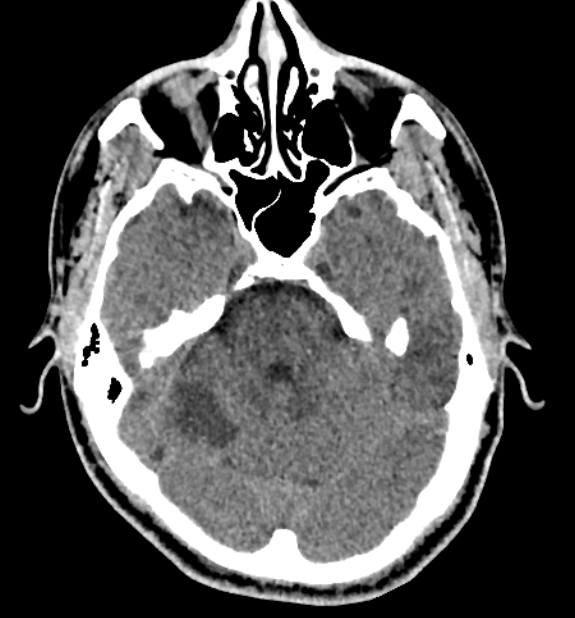 Acute ischemic stroke - posterior circulation territory (Radiopaedia 77670-89881 non-contrast 26).jpg