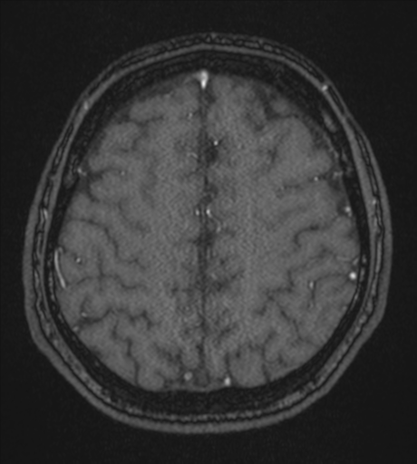 Acute left middle cerebral artery territory infarct with clot retrieval (Radiopaedia 47732-52433 Axial MRA 52).png