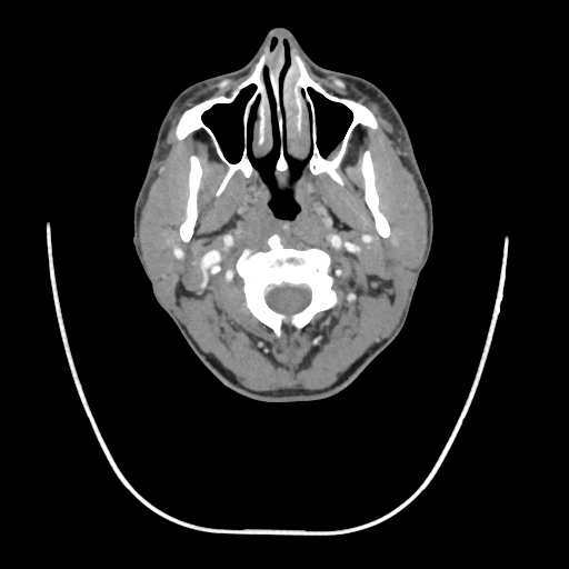 Acute longus colli calcific tendinitis (Radiopaedia 72495-83036 Axial C+ arterial phase 22).jpg