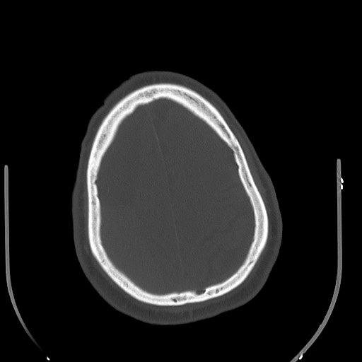 Acute on chronic subdural hematoma (Radiopaedia 78346-90966 D 68).jpg