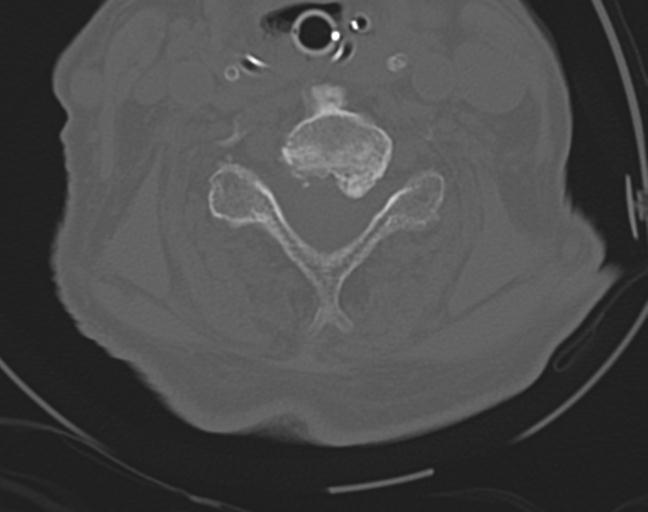 Acute on chronic subdural hematoma and thoracic vertebral injury in a multitrauma patient (Radiopaedia 31698-32619 Axial bone window 37).jpg