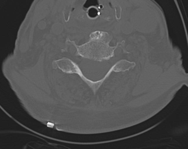 Acute on chronic subdural hematoma and thoracic vertebral injury in a multitrauma patient (Radiopaedia 31698-32619 Axial bone window 41).jpg