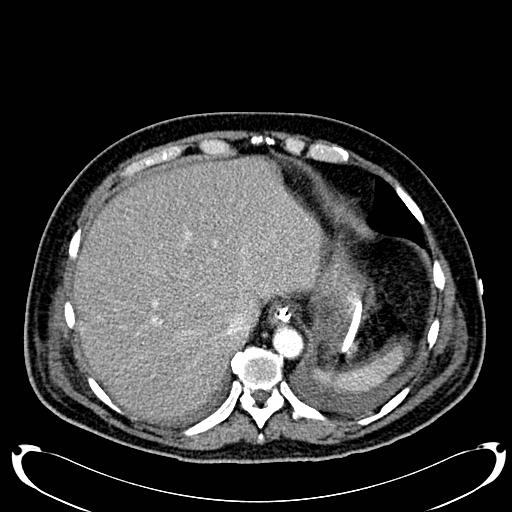 Acute pancreatic necrosis (Radiopaedia 13560-18500 Axial C+ portal venous phase 29).jpg