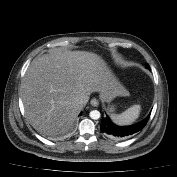 Acute pancreatitis (Radiopaedia 26663-26813 Axial C+ arterial phase 18).jpg
