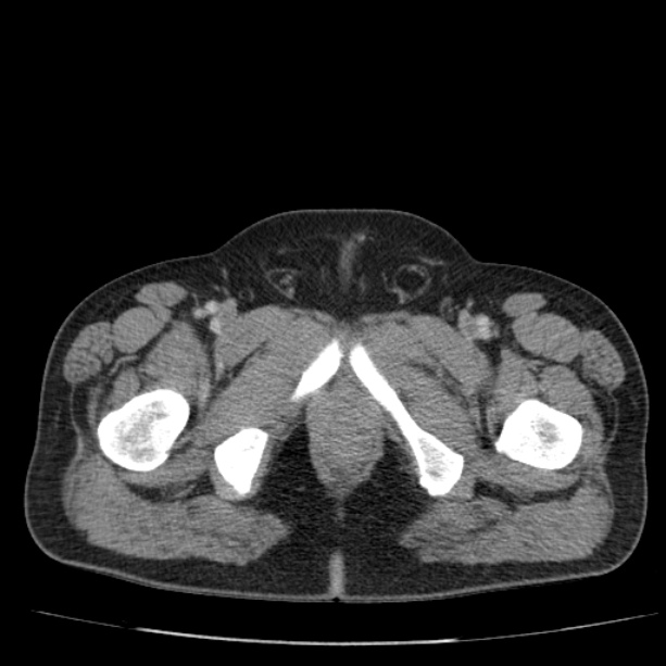 Acute pancreatitis (Radiopaedia 26663-26813 Axial C+ portal venous phase 91).jpg