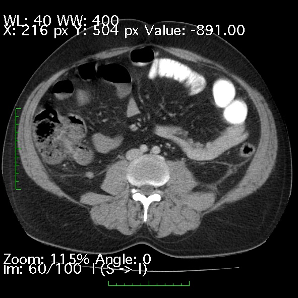 Acute pancreatitis (Radiopaedia 34043-35276 Axial C+ portal venous phase 60).jpg