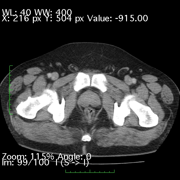 File:Acute pancreatitis (Radiopaedia 34043-35276 Axial C+ portal venous phase 99).jpg