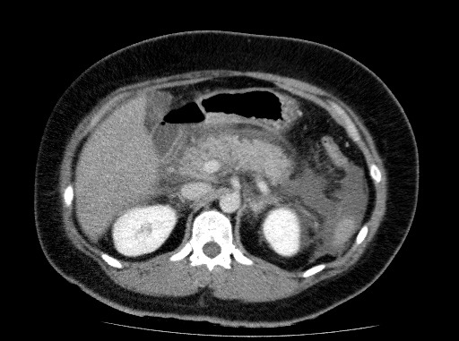 Acute pancreatitis (Radiopaedia 69236-79012 Axial C+ portal venous phase 32).jpg