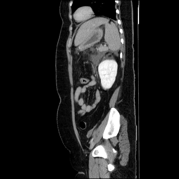 Acute pancreatitis (Radiopaedia 69236-79012 Sagittal C+ portal venous phase 34).jpg