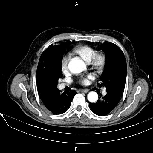 File:Acute pancreatitis (Radiopaedia 85146-100701 Axial C+ arterial phase 10).jpg