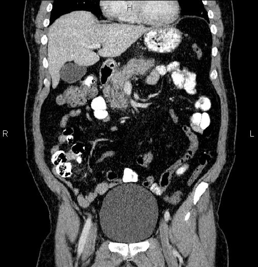 Acute pancreatitis (Radiopaedia 85390-101010 Coronal C+ portal venous phase 24).jpg