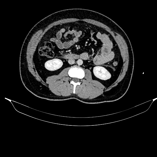 Acute pancreatitis (Radiopaedia 87428-103757 Axial C+ portal venous phase 50).jpg