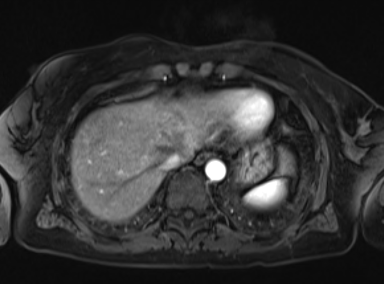 Acute pancreatitis - Balthazar E - post ERCP (Radiopaedia 27562-27778 Axial VIBE C+ 16).png