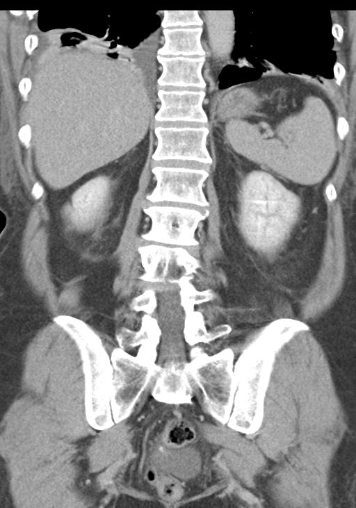 Acute pancreatitis and walled-off necrosis (Radiopaedia 29888-30403 E 42).jpg
