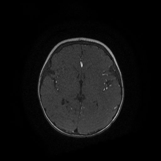 Acute phase of hemiconvulsion-hemiplegia epilepsy syndrome (Radiopaedia 29309-29745 Axial TOF angiography 51).jpg