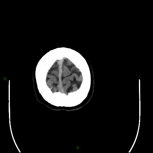 File:Acute posterior cerebral artery territory infarct (Radiopaedia 79329-92393 Axial non-contrast 105).jpg