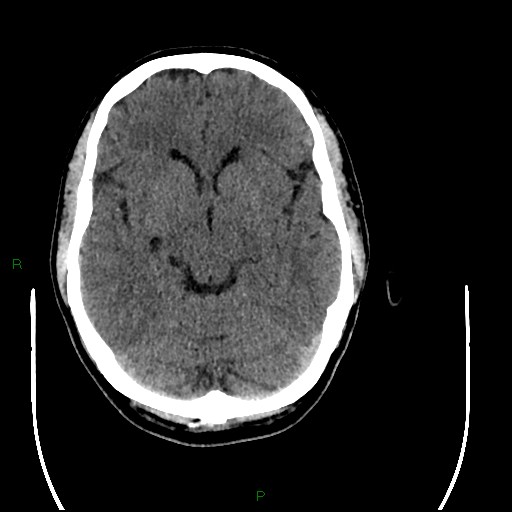 Acute posterior cerebral artery territory infarct (Radiopaedia 79329-92393 Axial non-contrast 45).jpg