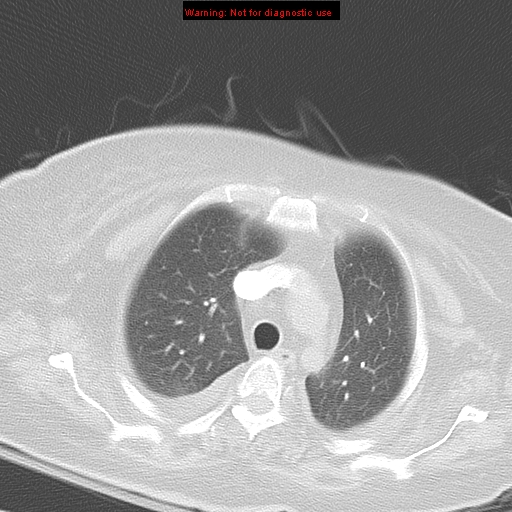 File:Acute pulmonary embolism (Radiopaedia 13286-13289 B 11).jpg