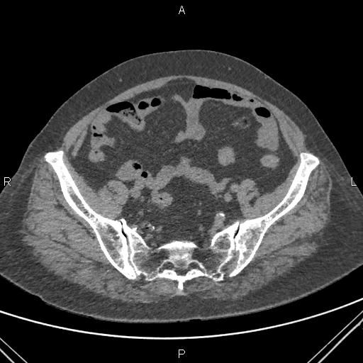 File:Acute renal artery occlusion (Radiopaedia 86586-102682 Axial non-contrast 72).jpg