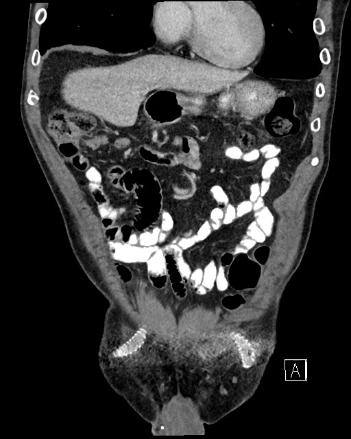Acute renal infarction - rim capsular enhancement (Radiopaedia 59833-67270 Coronal C+ portal venous phase 5).jpg
