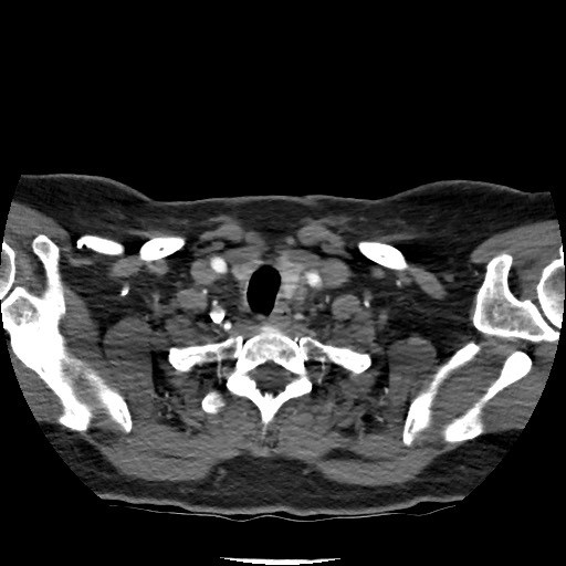 Acute subarachnoid hemorrhage and accessory anterior cerebral artery (Radiopaedia 69231-79009 Axial C+ arterial phase 30).jpg