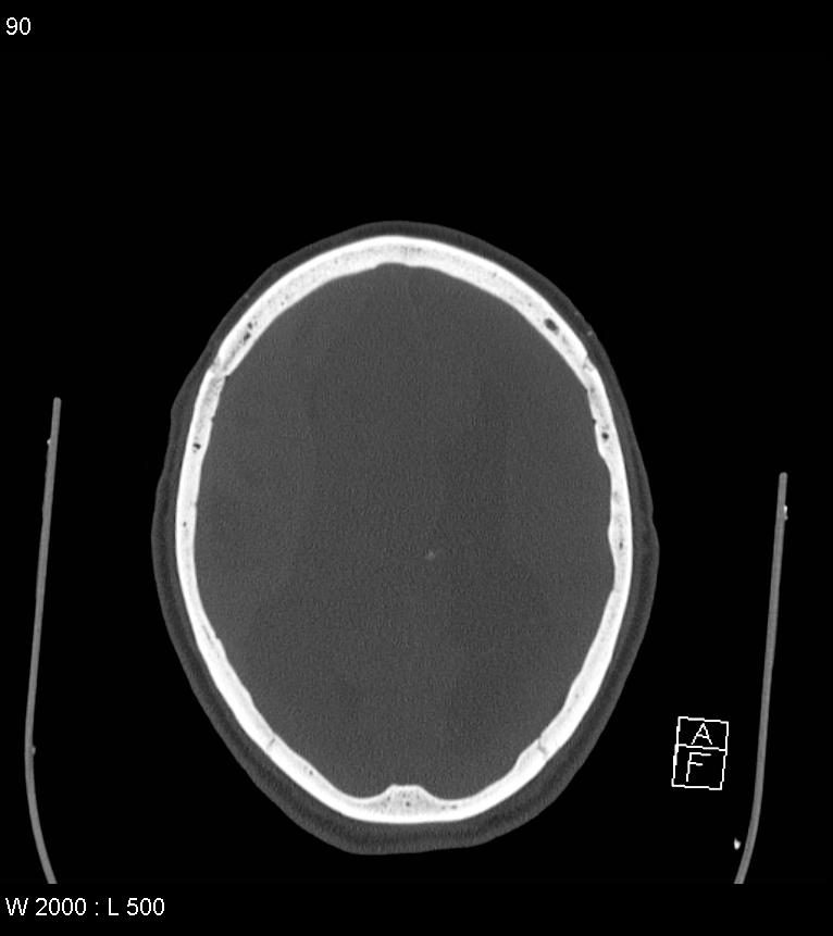 Acute subdural hematoma with myelofibrosis (Radiopaedia 52582-58494 Axial bone window 45).jpg