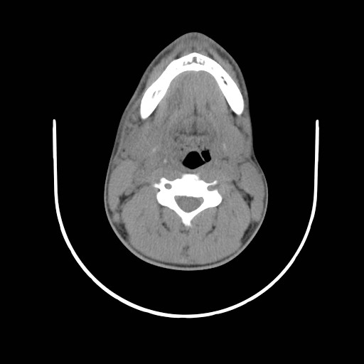 File:Acute submandibular sialadenitis secondary to ductal stone (Radiopaedia 27999-28267 Axial non-contrast 14).jpg