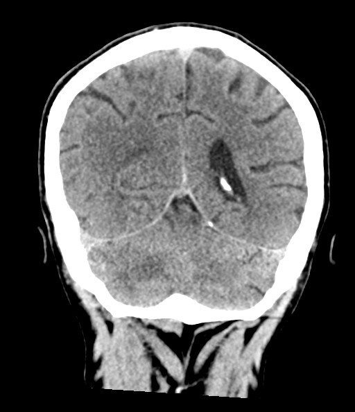 Acute superior cerebellar artery territory infarct (Radiopaedia 84104-99359 Coronal non-contrast 65).jpg