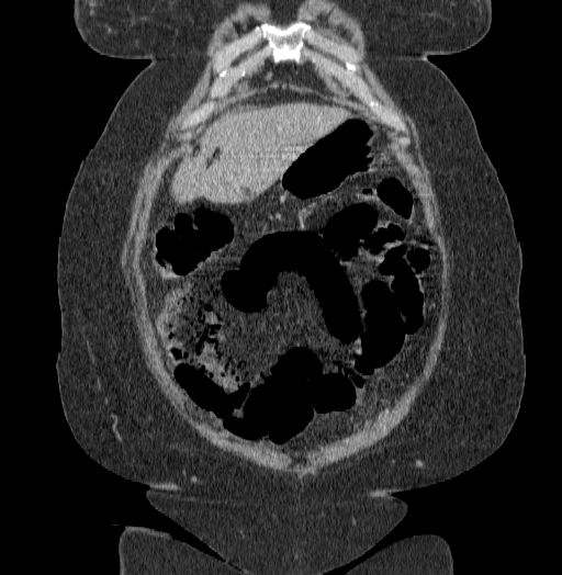 Acute superior mesenteric artery occlusion (Radiopaedia 51288-56960 Coronal C+ portal venous phase 16).jpg