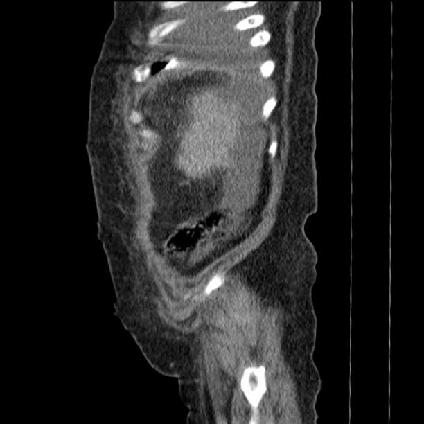 Acute tubular necrosis (Radiopaedia 28077-28334 H 14).jpg