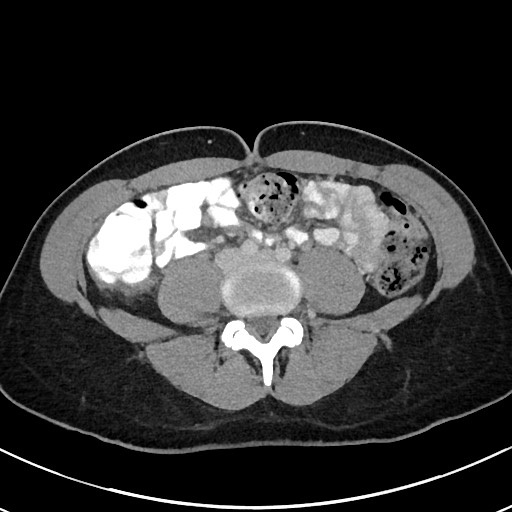 File:Acute uncomplicated appendicitis (Radiopaedia 61374-69304 Axial C+ portal venous phase 71).jpg