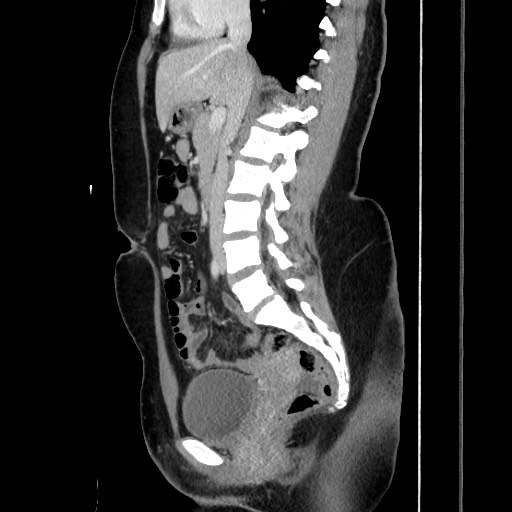 File:Acute uncomplicated appendicitis (Radiopaedia 73704-84499 Sagittal C+ portal venous phase 107).jpg