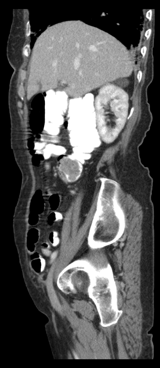 Adenocarcinoma of cecum (Radiopaedia 59222-66549 Sagittal C+ portal venous phase 71).jpg