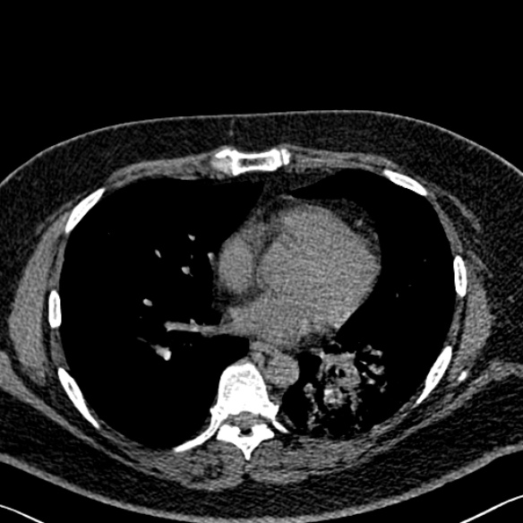 Adenoid cystic carcinoma of the trachea (Radiopaedia 49042-54137 Axial non-contrast 205).jpg