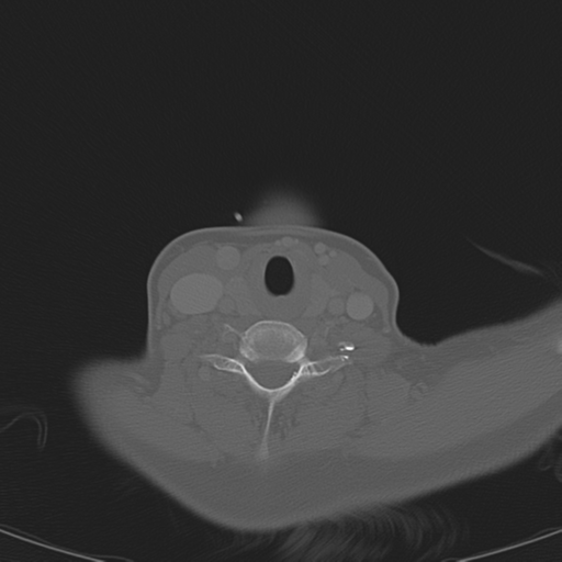 Adenoid cystic tumor of palate (Radiopaedia 46980-51518 Axial bone window 54).png