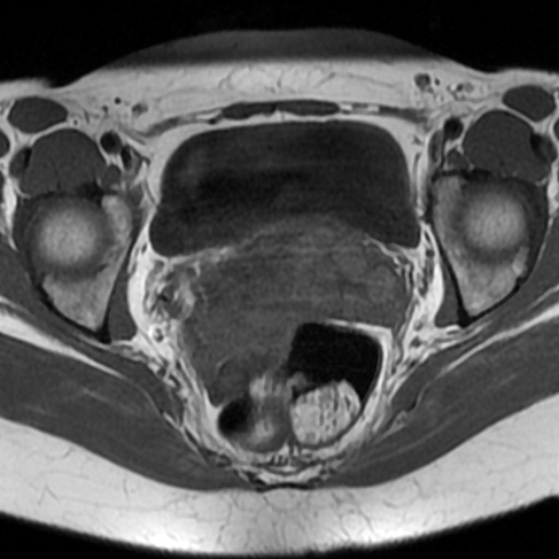 File:Adenoma malignum of cervix (Radiopaedia 66441-75705 Axial T1 10).jpg