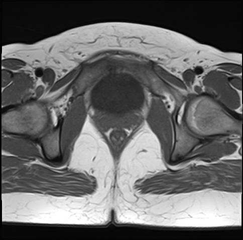 File:Adenomyosis - ovarian endometriomas (Radiopaedia 67031-76350 Axial T1 23).jpg