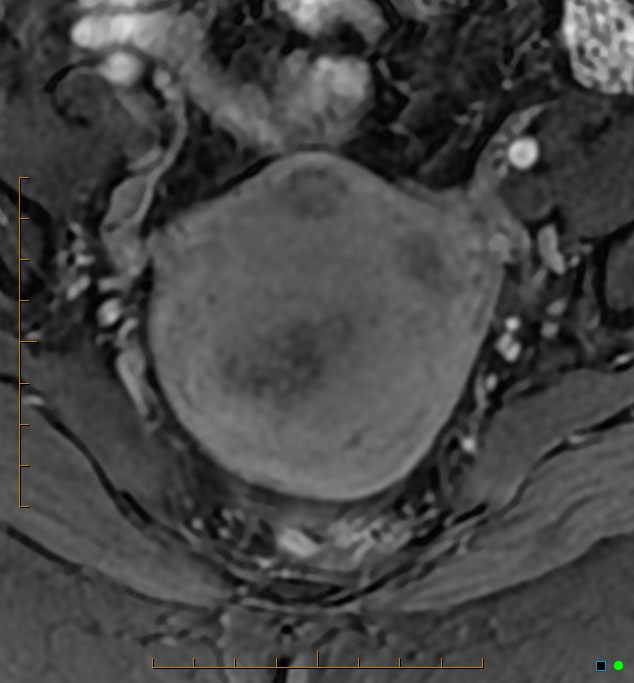 Adenomyosis uterus with hematometra (Radiopaedia 45779-50011 Axial T1 C+ fat sat 19).jpg