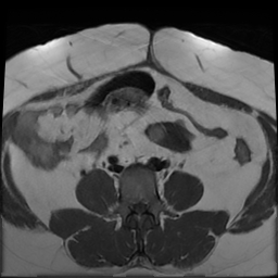 File:Adenomyosis within a didelphys uterus (Radiopaedia 70175-80215 Axial T1 9).jpg