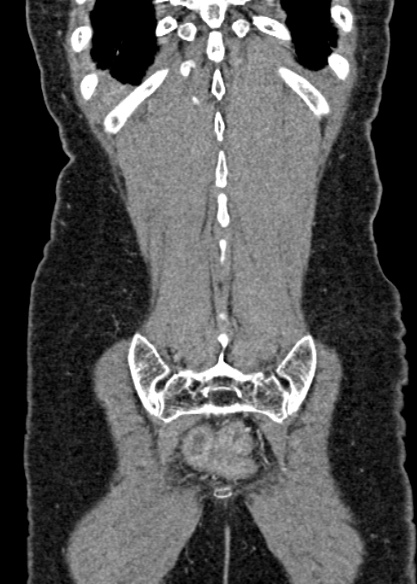Adhesional small bowel obstruction (Radiopaedia 48397-53305 Coronal C+ portal venous phase 308).jpg