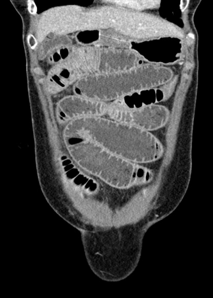 Adhesional small bowel obstruction (Radiopaedia 48397-53305 Coronal C+ portal venous phase 72).jpg