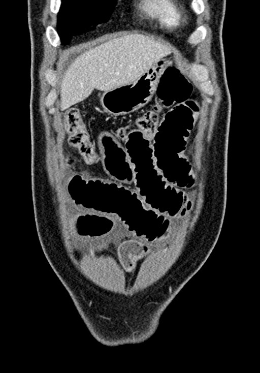 Adhesional small bowel obstruction (Radiopaedia 58900-66131 Coronal C+ portal venous phase 77).jpg
