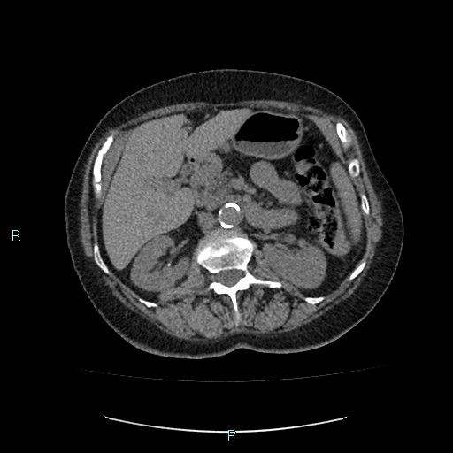File:Adrenal collision tumor (ACT) (Radiopaedia 48462-53379 Axial non-contrast 21).jpg