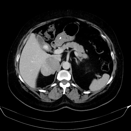 File:Adrenal cortical carcinoma (Radiopaedia 64017-72769 Axial C+ portal venous phase 20).jpg