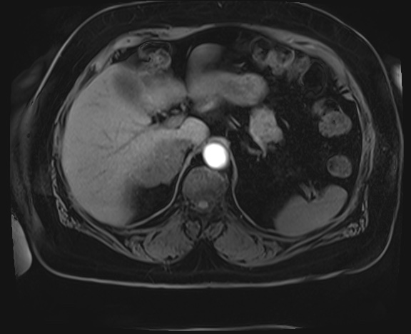 Adrenal cortical carcinoma (Radiopaedia 64017-72770 Axial T1 C+ fat sat 4).jpg