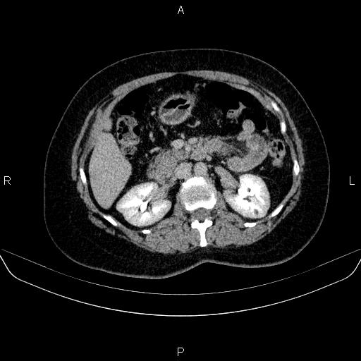 Adrenal cortical carcinoma (Radiopaedia 84882-100379 Axial C+ delayed 34).jpg